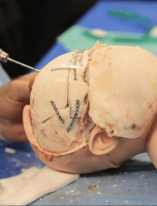 Neurosurgery