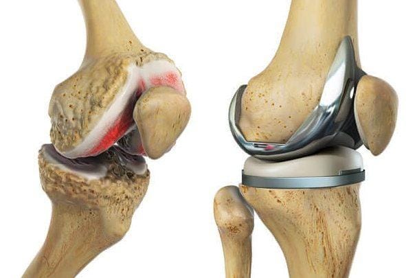 joint replacement surgery in Prayagraj